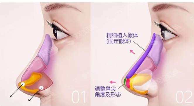 鼻部整形较新价目表2021,隆鼻的材料有哪些?肋软骨隆鼻案例分享