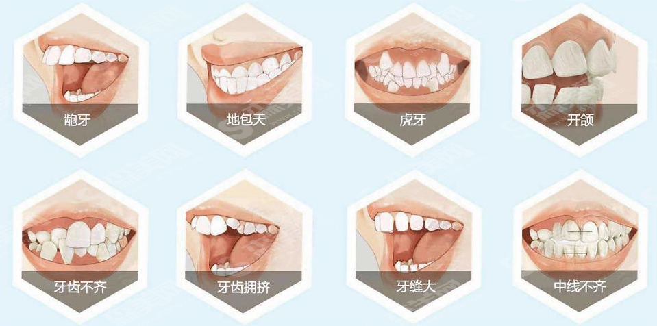 四川大学华西口腔医院怎么样?牙齿矫正的恢复果怎么样?牙齿矫正适应哪些人群?