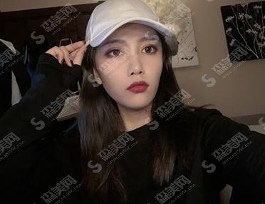 上海第九人民医院整形科价格表一览,内含面部埋线提升术后恢复反馈