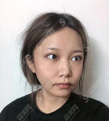 上海第九人民医院整形科价格表一览,内含面部埋线提升术后恢复反馈