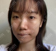 浙二医院光子嫩肤怎么样?价目表2021公布,内含光子嫩肤案例分享