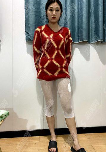 浙一医院整形科价目表2021,内含水动力吸脂瘦大腿恢复分享