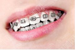 牙套的价格是多少？牙齿矫正的果如何？附带牙套的注意事项及案例分享