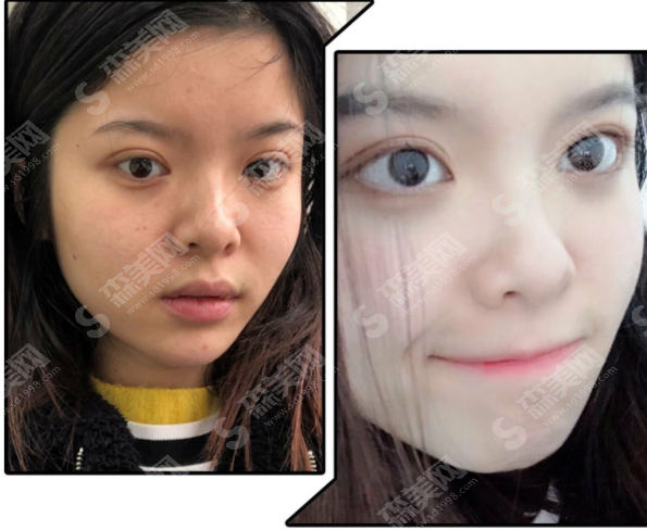 玻尿酸隆鼻的果好吗?玻尿酸隆鼻的注意事项及案例分享,附2021较新价目表