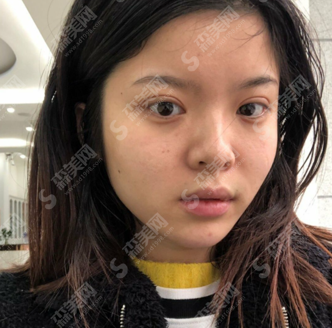 玻尿酸隆鼻的果好吗?玻尿酸隆鼻的注意事项及案例分享,附2021较新价目表