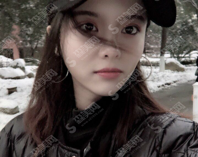 玻尿酸隆鼻的果好吗?玻尿酸隆鼻的注意事项及案例分享,附2021较新价目表