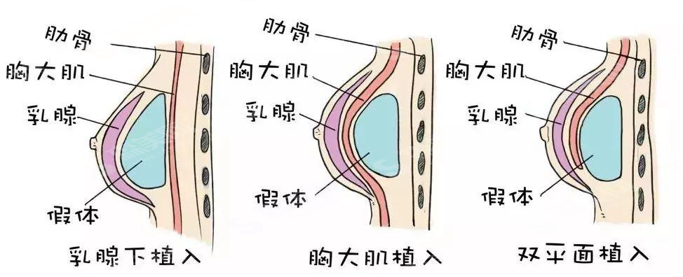 丰胸价格一览表2021,内含上海九院隆胸案例分享及术后注意事项