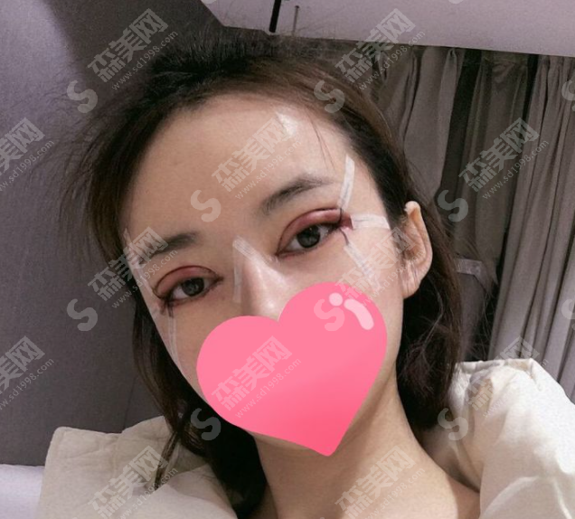 做的双眼皮果怎么样?附恢复过程及2021较新价目表