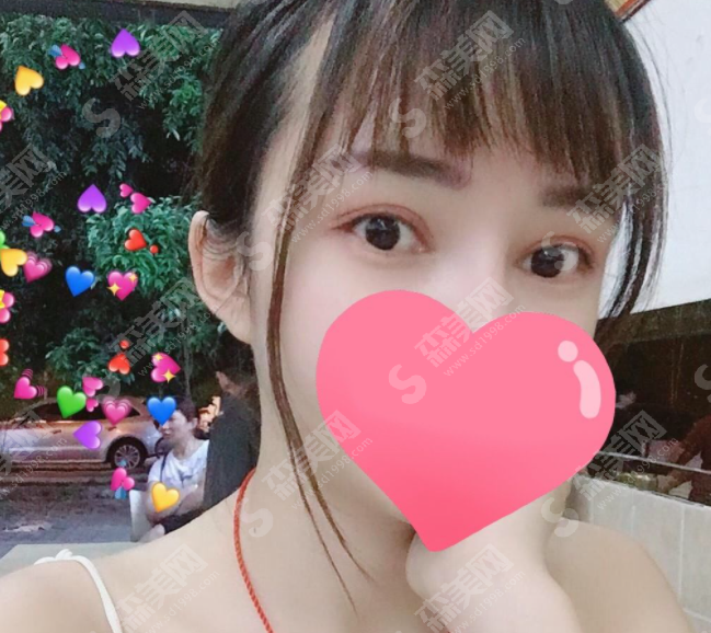 做的双眼皮果怎么样?附恢复过程及2021较新价目表