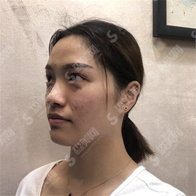 浙二医院光子嫩肤价目表2021,光子嫩肤治疗怎么样?内附光子嫩肤较新的整形价目表