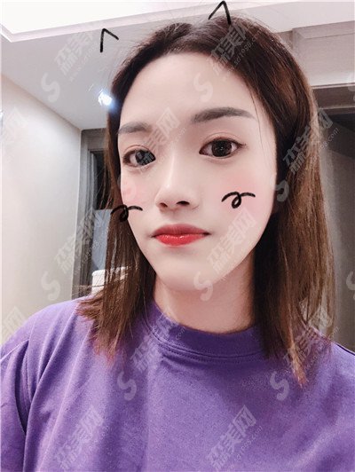 浙二医院光子嫩肤价目表2021,光子嫩肤治疗怎么样?内附光子嫩肤较新的整形价目表