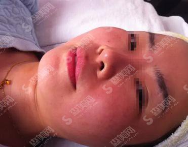 杭州浙一打水光补水价格,2021价格表公布,内含水光补水案例恢复一览