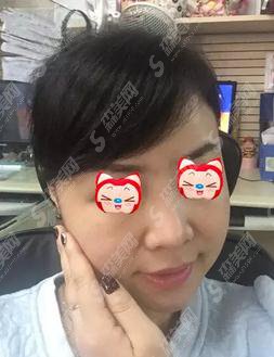 杭州浙一打水光补水价格,2021价格表公布,内含水光补水案例恢复一览