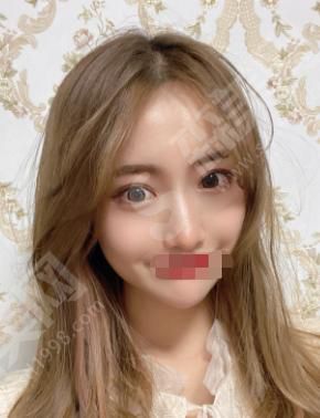 东莞玛利亚做的双眼皮果怎么样？附医师介绍及案例分享