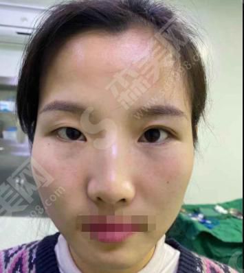 上海美仑整形医院做的双眼皮怎么样？附医师介绍及案例分享