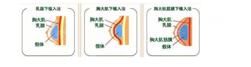 丰胸价目表2021,硅胶丰胸的优势是什么?硅胶丰胸术后应该如何护理?