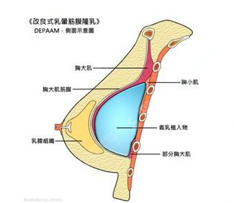 丰胸价目表2021,硅胶丰胸的优势是什么?硅胶丰胸术后应该如何护理?