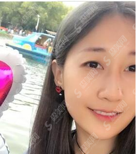 双眼皮价目表2021,埋线双眼皮案例分享/选择医院的标准是什么