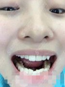 呼和浩特欧贝口腔价格2021，内含牙齿矫正的真实案例