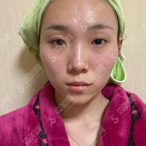 上海美联臣医疗美容医院怎么样?医院实力/医生/颧骨颧弓降低手术果