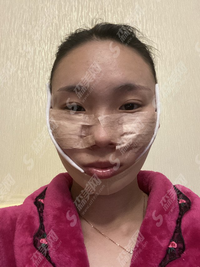 上海美联臣医疗美容医院怎么样?医院实力/医生/颧骨颧弓降低手术果