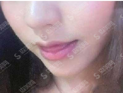 膨体丰下巴价目表2021,内附膨体丰下巴案例分享及术后注意事项