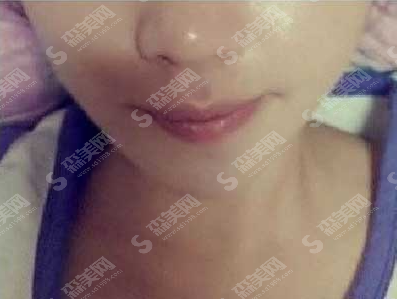 膨体丰下巴价目表2021,内附膨体丰下巴案例分享及术后注意事项