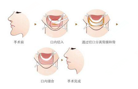 去眼袋价格一览表2021,去眼袋的方法有哪些,去眼袋失败的类型有哪些