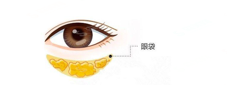 去眼袋价格一览表2021,去眼袋的方法有哪些,去眼袋失败的类型有哪些