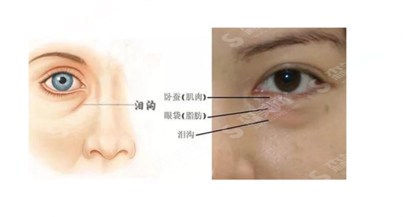 去眼袋价格一览表2021,去眼袋的方法有哪些,去眼袋失败的类型有哪些