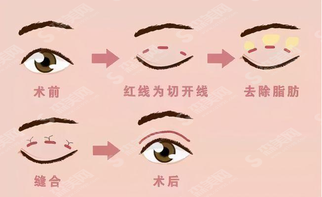 压线双眼皮案例分享,附双眼皮术后注意事项及双眼皮价格一览表2021