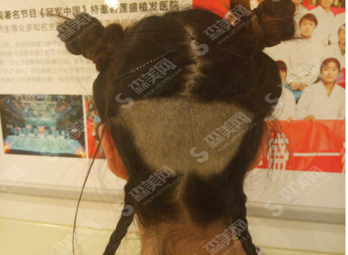 发际线种植的果好吗?附发际线种植案例分享/术后护理/价格表2021