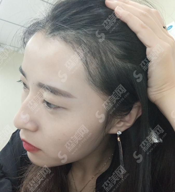 发际线种植的果好吗?附发际线种植案例分享/术后护理/价格表2021