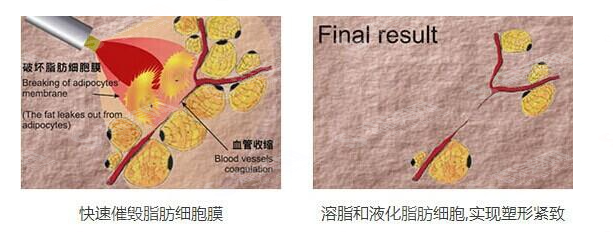 光纤溶脂手术的果如何?光纤溶脂的优缺点及吸脂价目表2021