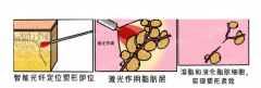 光纤溶脂手术的果如何？光纤溶脂的优缺点及吸脂价目表2021