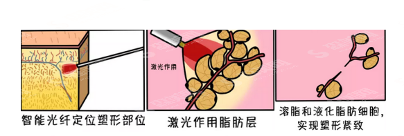 光纤溶脂手术的果如何?光纤溶脂的优缺点及吸脂价目表2021