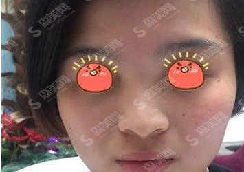 赵廷勇医生隆鼻的果怎么样?附自体耳软骨隆鼻案例分享/术后果