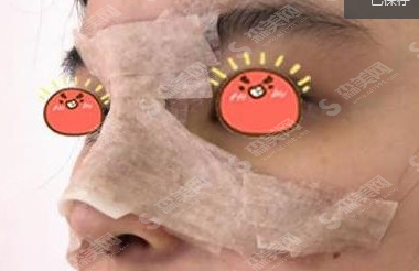 赵廷勇医生隆鼻的果怎么样?附自体耳软骨隆鼻案例分享/术后果