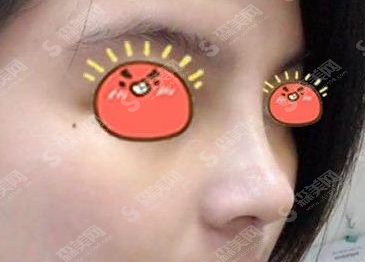 赵廷勇医生隆鼻的果怎么样?附自体耳软骨隆鼻案例分享/术后果