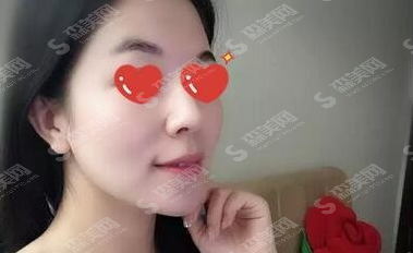玻尿酸去颈纹的果怎么样?附玻尿酸去颈纹的维持时间/案例分享/玻尿酸价目表2021