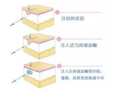 玻尿酸去颈纹的果怎么样?附玻尿酸去颈纹的维持时间/案例分享/玻尿酸价目表2021
