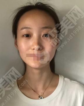 深圳美莱整形医院做的双眼皮果如何？附医院简介/医师介绍及案例分享