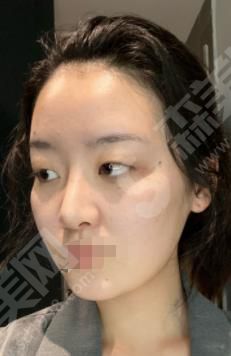 芳艺整形医院做的双眼皮果如何？附医师介绍及案例分享