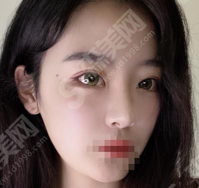 芳艺整形医院做的双眼皮果如何？附医师介绍及案例分享