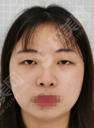 郑州华山整形医院做的双眼皮果如何？附医师介绍及案例分享