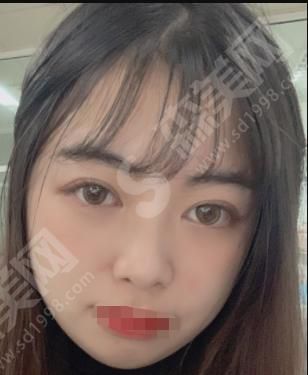 郑州华山整形医院做的双眼皮果如何？附医师介绍及案例分享