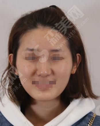 荆州华美整形医院做的整形果如何?附医师介绍及隆鼻案例分享