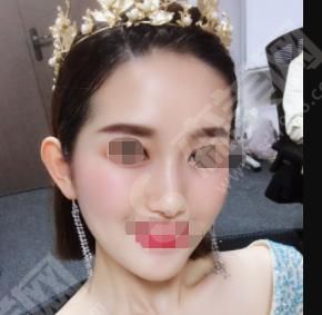 荆州华美整形医院做的整形果如何?附医师介绍及隆鼻案例分享