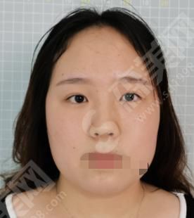 成都华西医院整形科做的整形果如何？附医师介绍及双眼皮案例分享