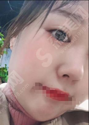 成都华西医院整形科做的整形果如何？附医师介绍及双眼皮案例分享